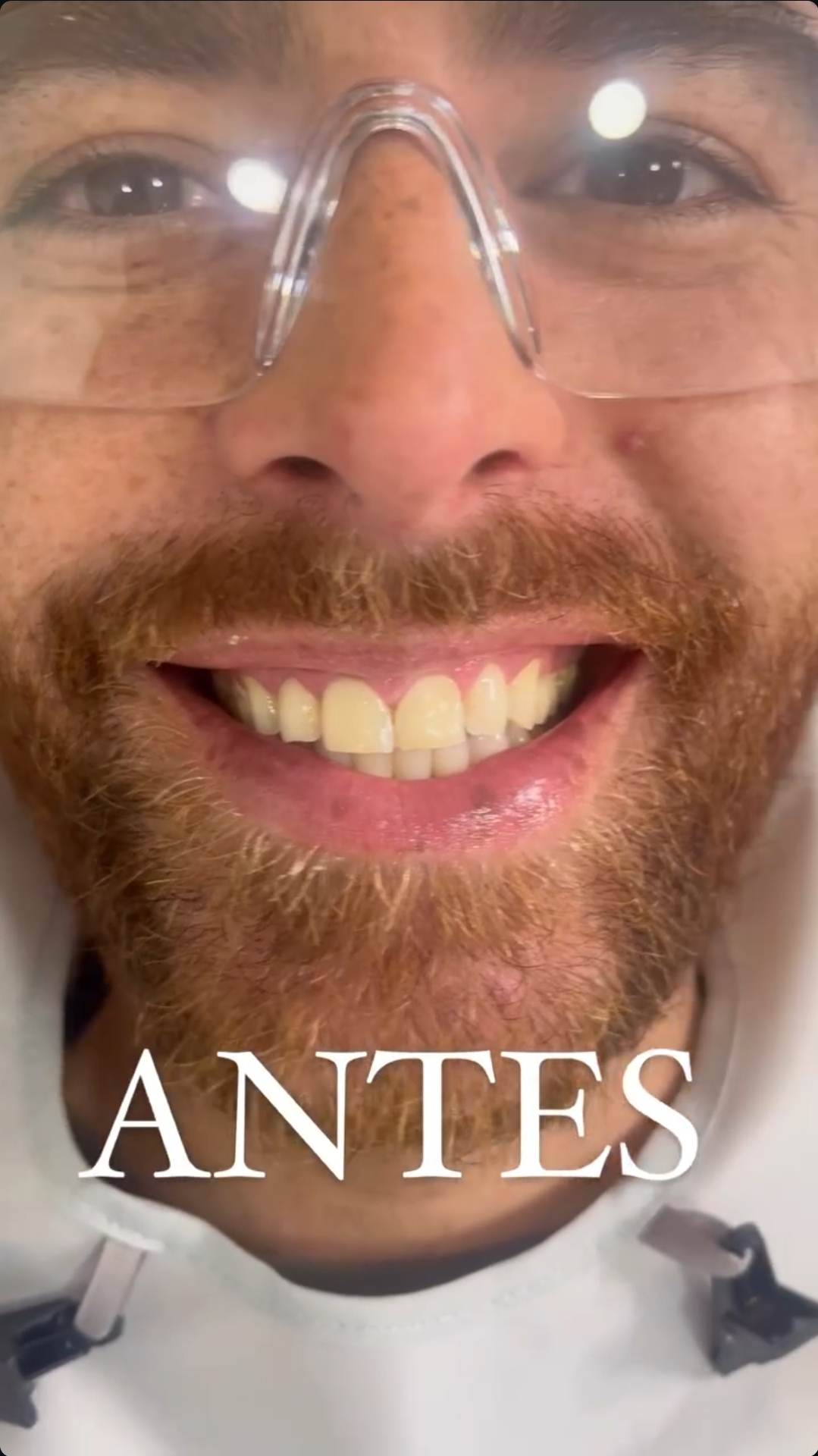 Antes del diseño de sonrisa