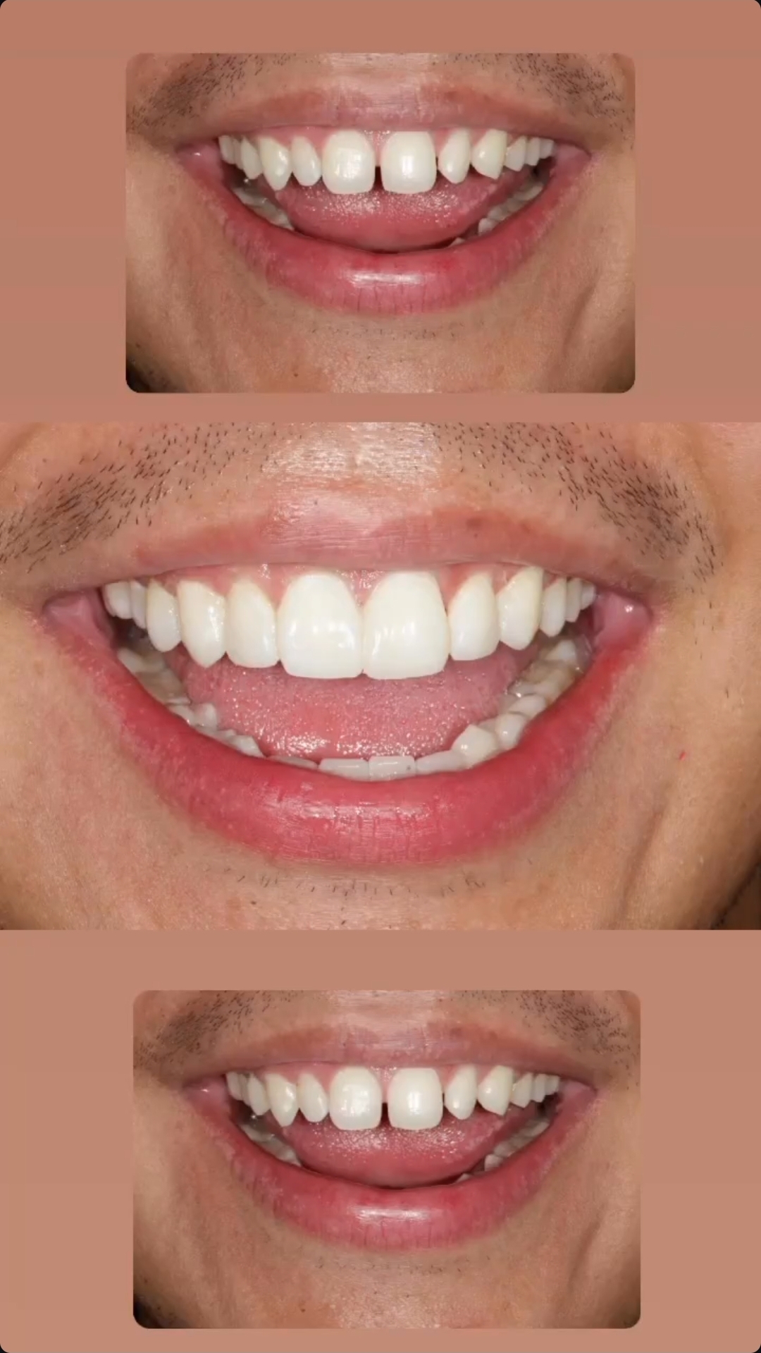 Diseño de sonrisa — tres vistas