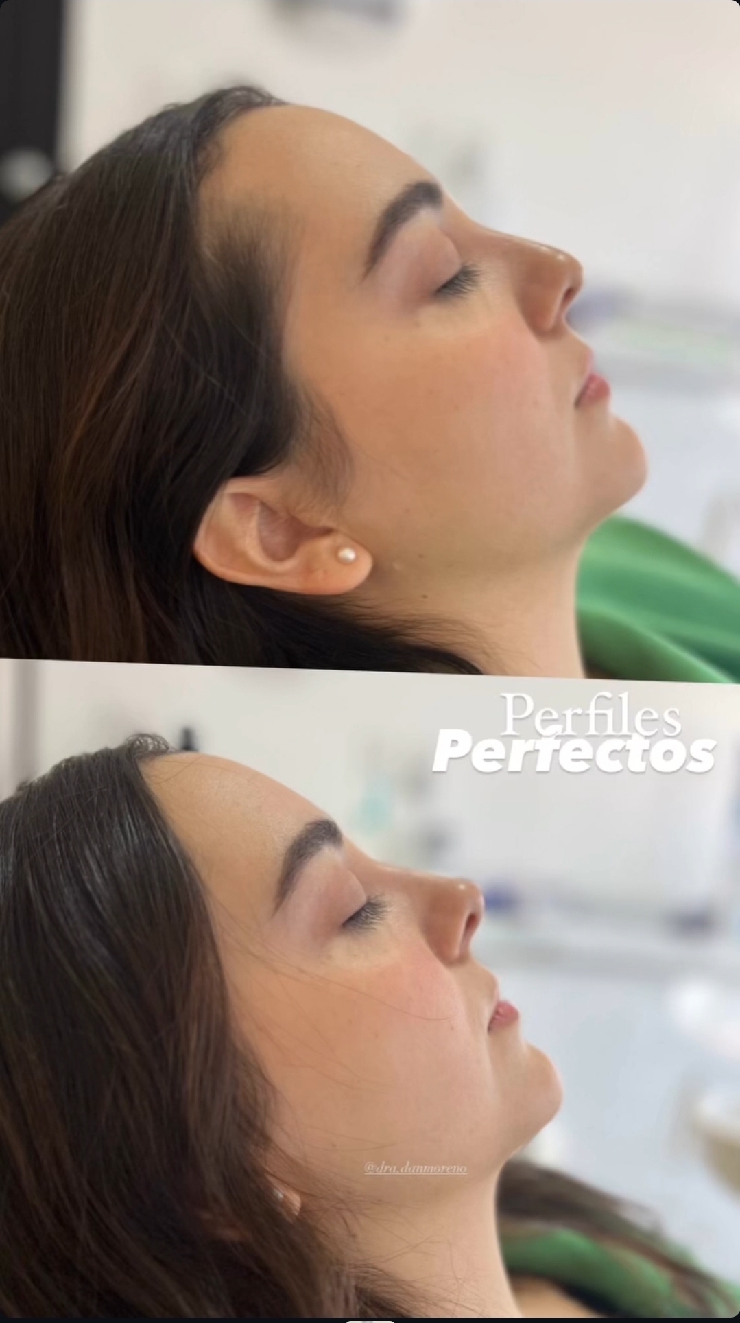 Rinomodelación — perfiles perfectos